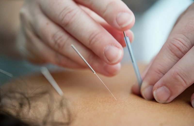 Acupuncture needles bein inserted.